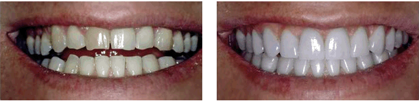 Porcelain Veneers / Teeth Whitening