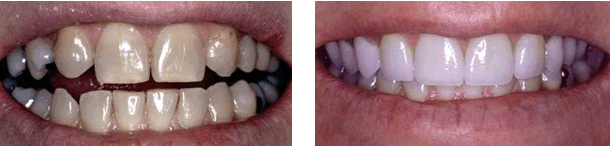 Teeth Whitening / Porcelain Veneers and Crowns